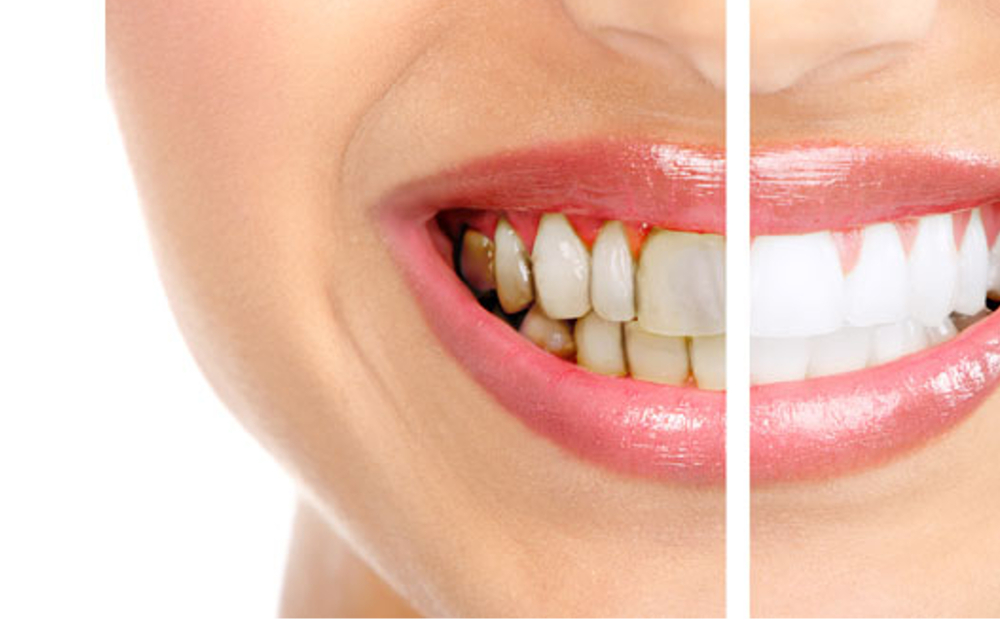 Igiene dentale e sbiancamento -77% di sconto