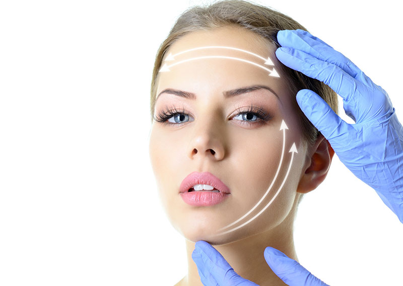 Soft lifting con fili in polidoxanone su zone a scelta  -70% di sconto