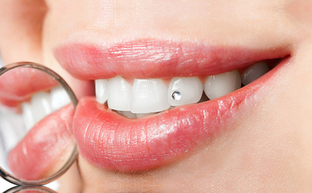 Applicazione brillantino dente -50% di sconto