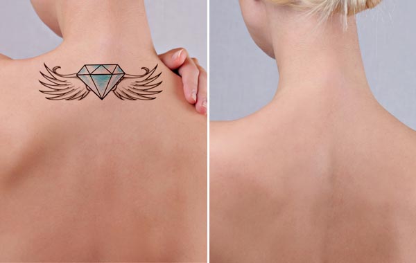 2 Sedute RIMOZIONE TATUAGGIO LASER a Maniago -71% di sconto